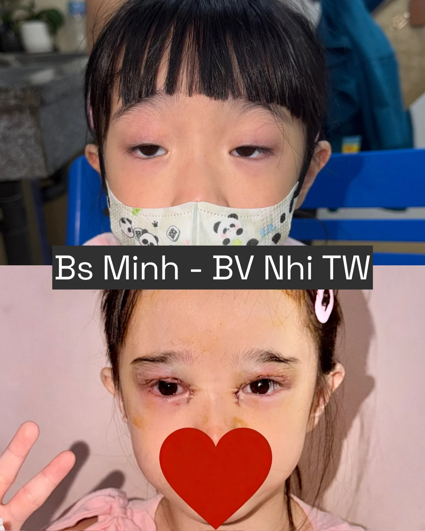 Sụp mi bẩm sinh trước và sau phẫu thuật