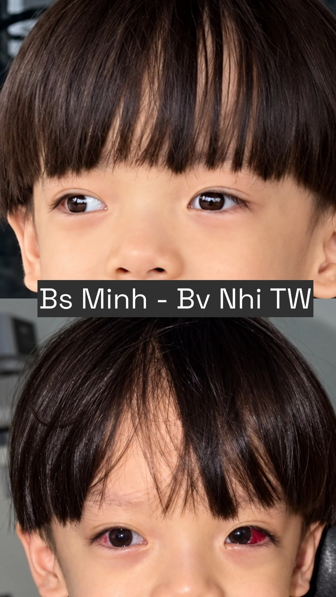 Lác trong ở trẻ nhỏ trước và sau phẫu thuật