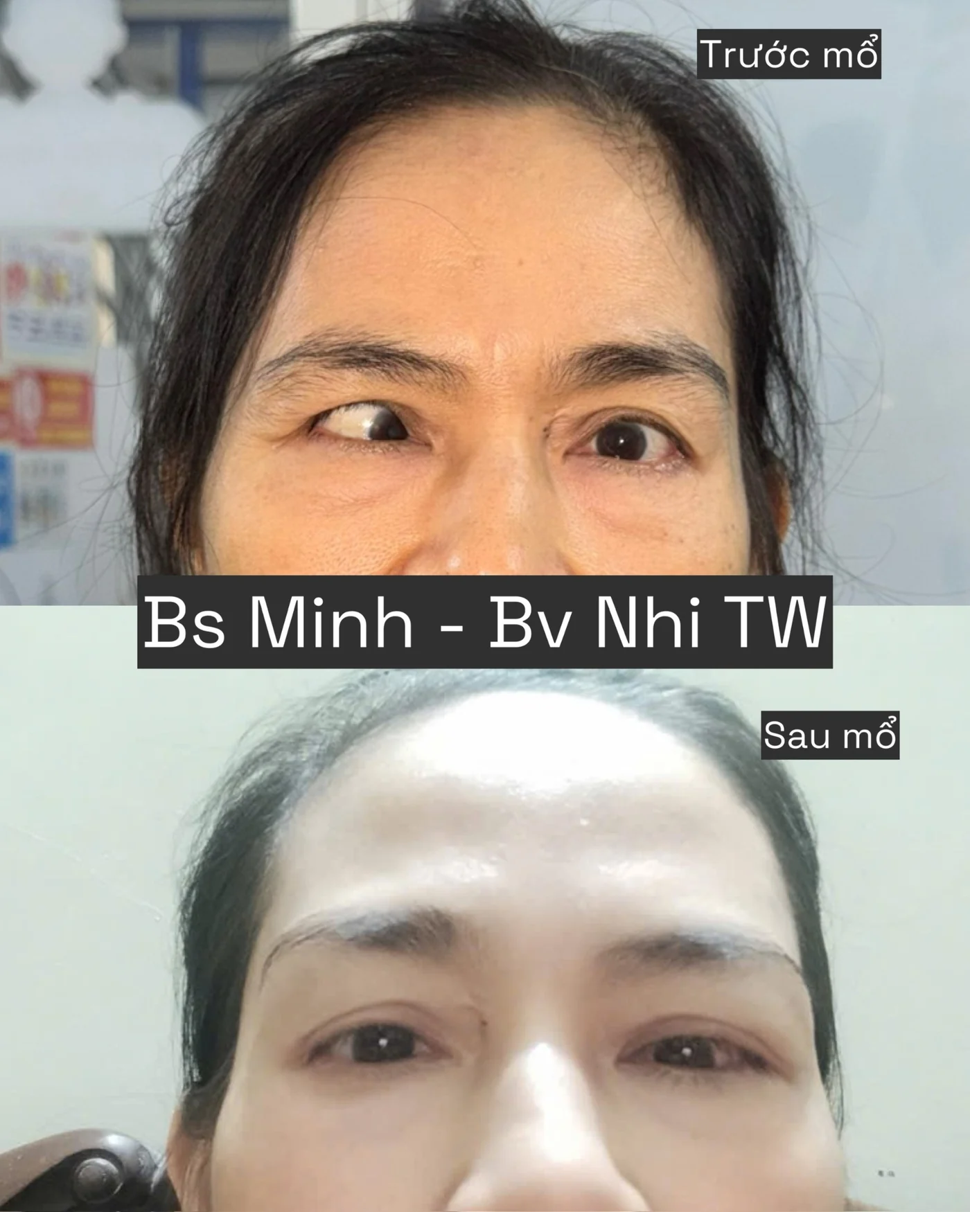 Lác góc lớn trước và sau can thiệp